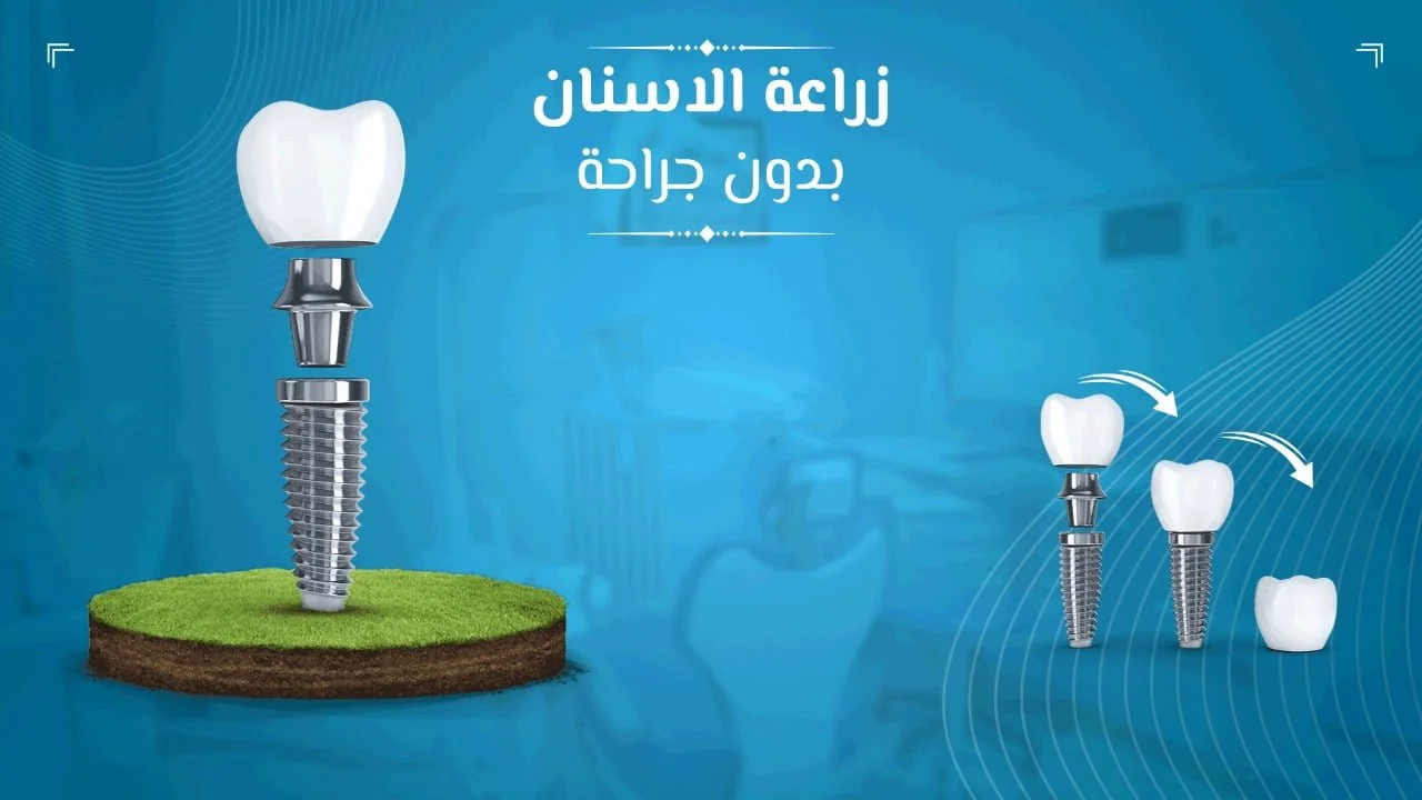 زراعة الاسنان بدون جراحه