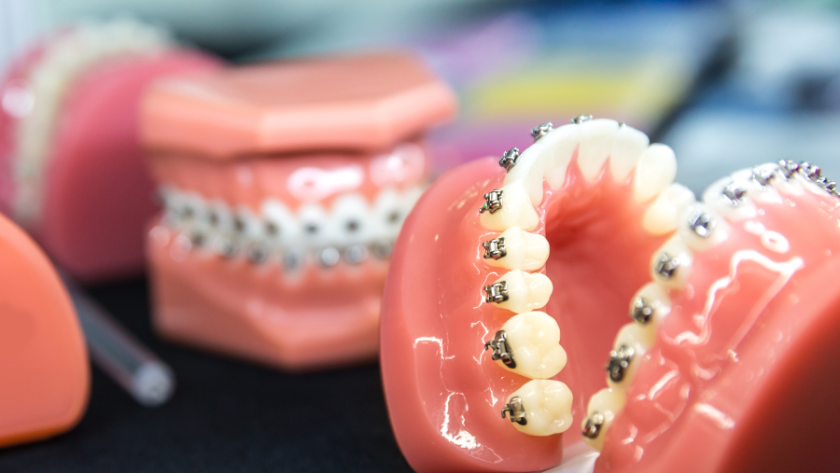 انواع تقويم الاسنان