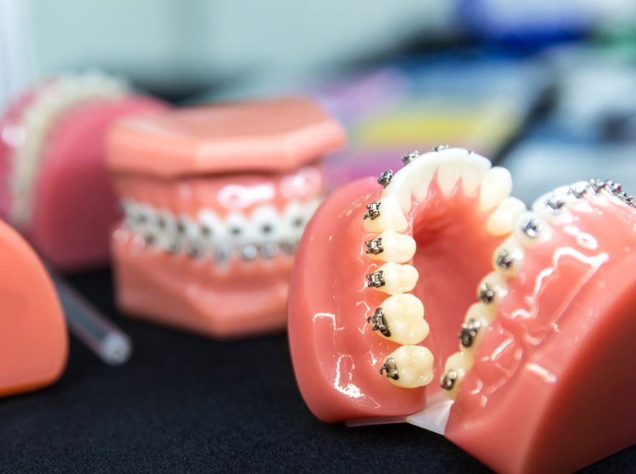 انواع تقويم الاسنان