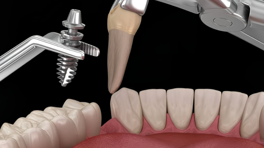 هل زراعة الاسنان مؤلمة؟