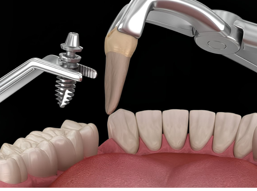 هل زراعة الاسنان مؤلمة؟