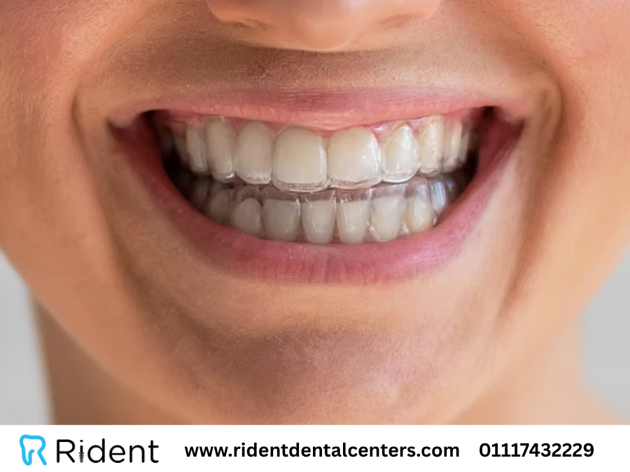 8 معلومات هامة عن التقويم الشفاف يجب معرفتها