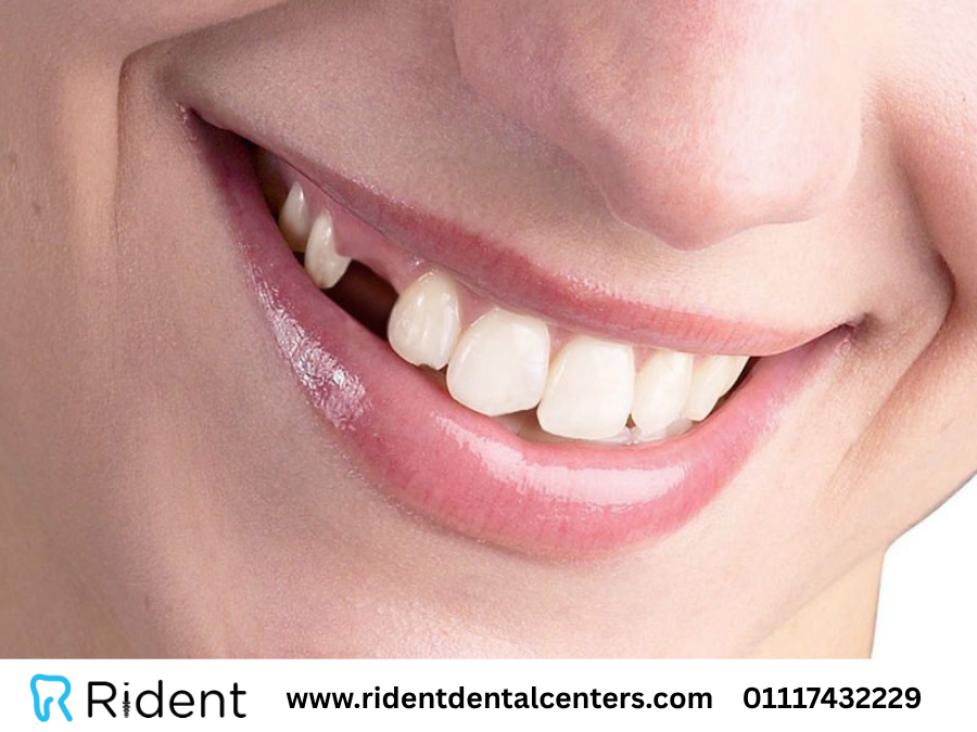 9 أسباب لـ سقوط زراعة الأسنان وما حل تلك المشكلة؟