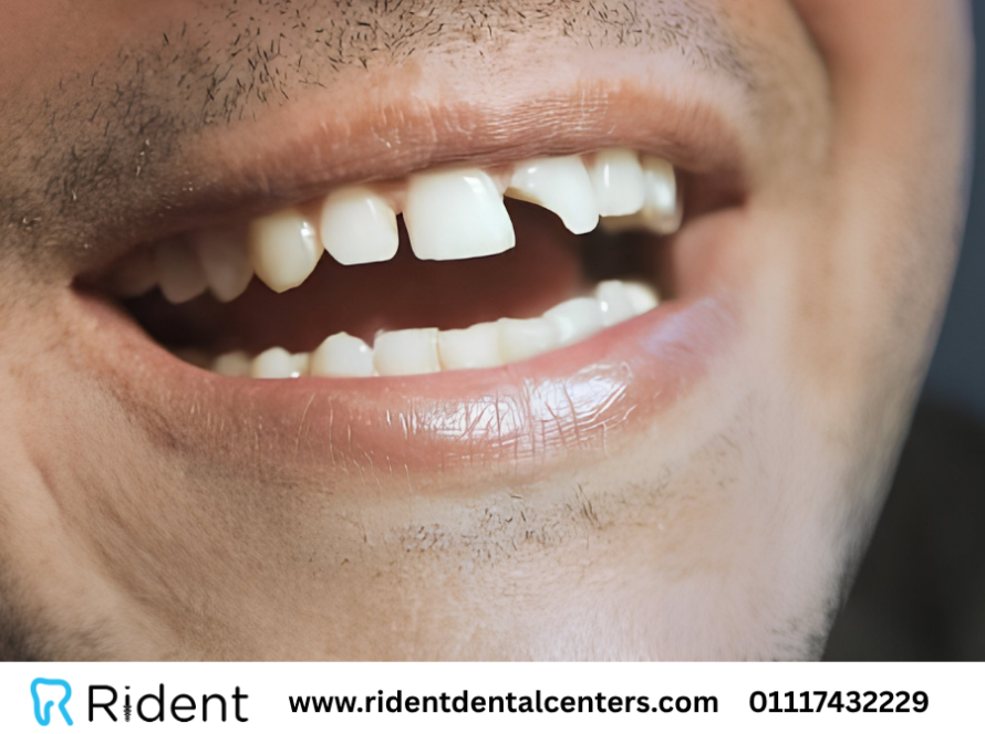 أسباب كسر الاسنان وعلاجه بـ 5 طرق مختلفة