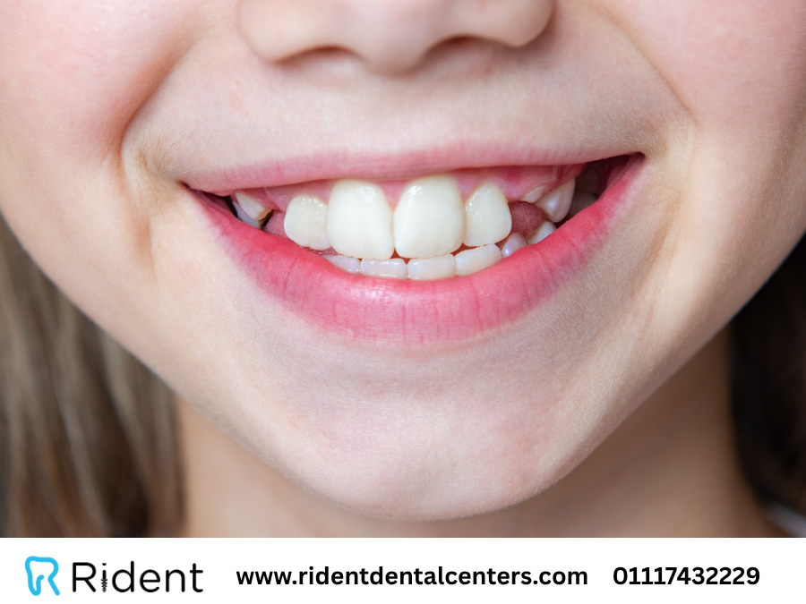 6 أسئلة وأجوبة عن تسوس الاسنان عند الاطفال