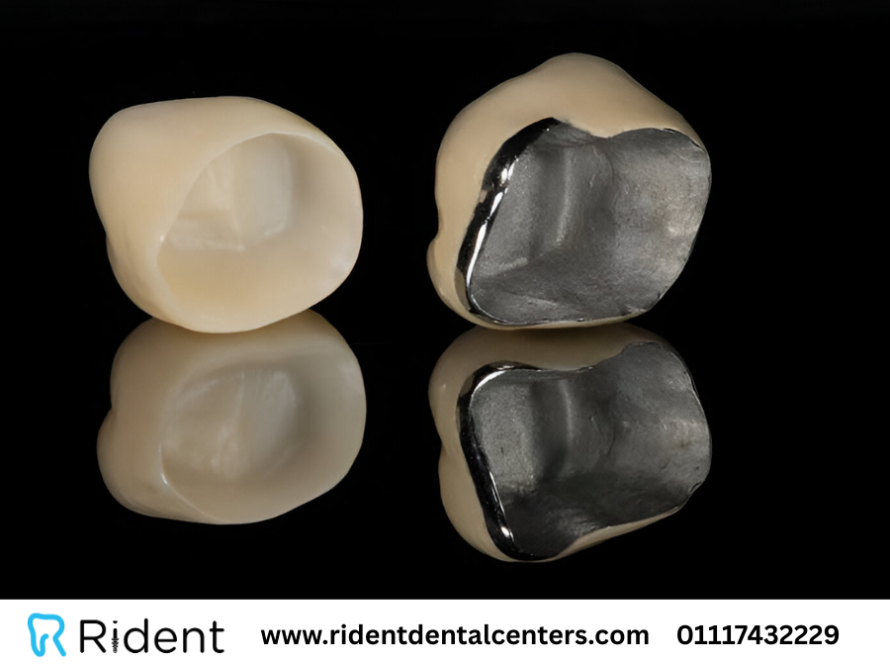 تيجان للاسنان