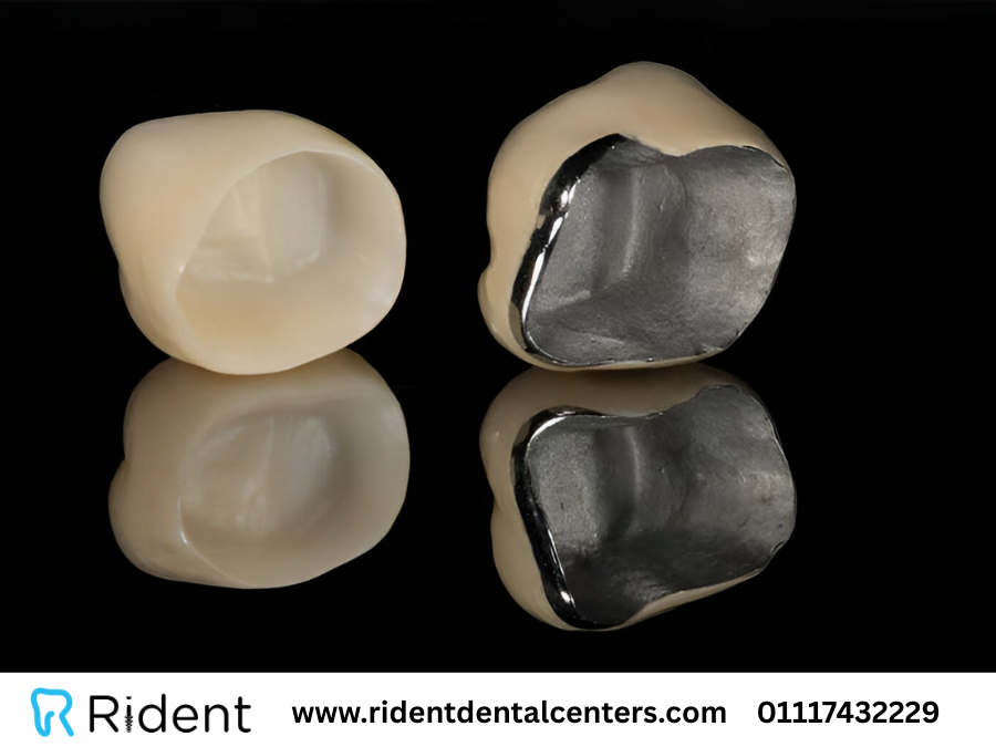 تيجان للاسنان