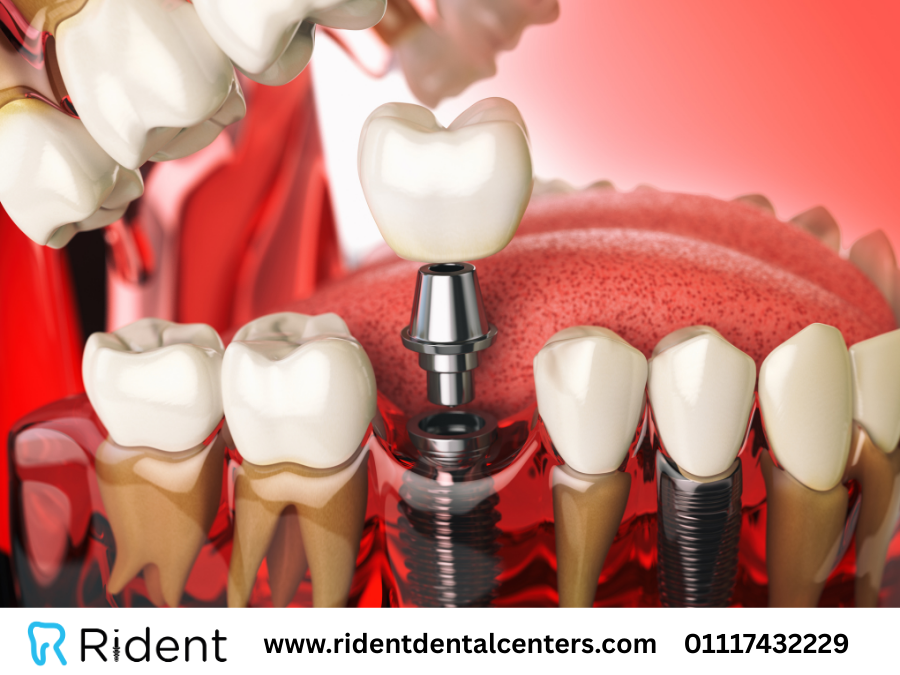 أنواع تركيبات الاسنان وأشهر 4 تركيبات لابتسامة رائعة