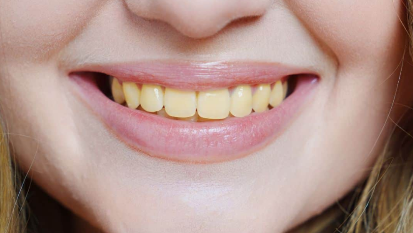 اسباب اصفرار الاسنان وتراكم الجير عليها