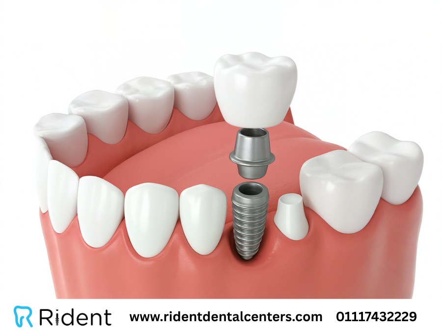 ما هو الفرق بين تركيب وزراعة الاسنان ؟