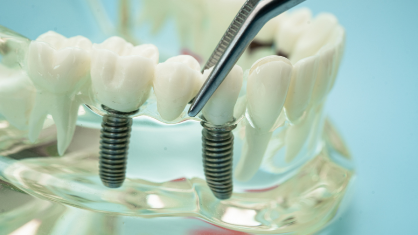 انواع زراعة الاسنان