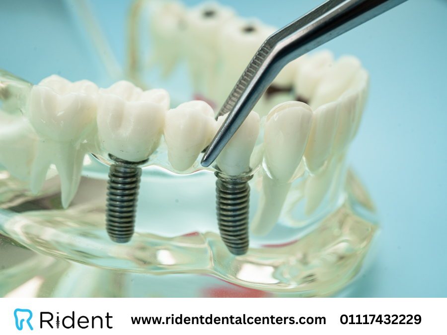 انواع زراعة الاسنان