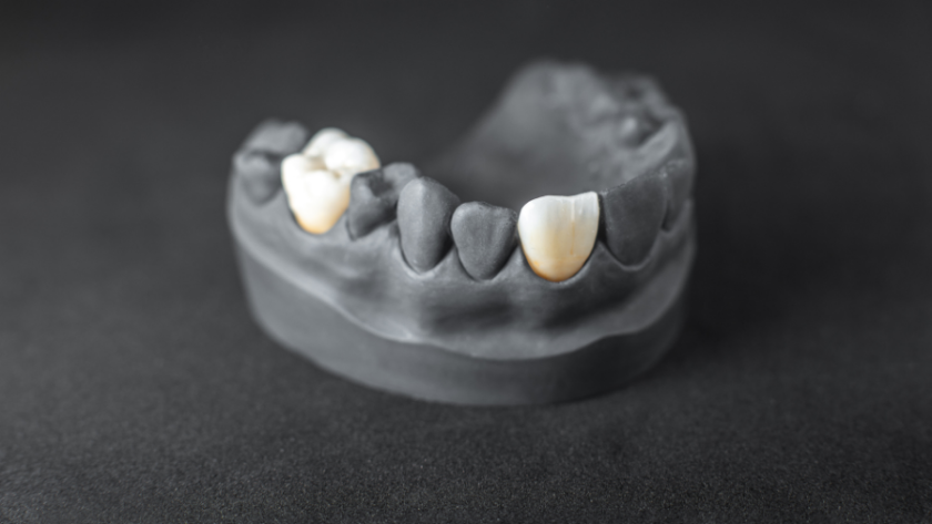 اسعار كراون الاسنان