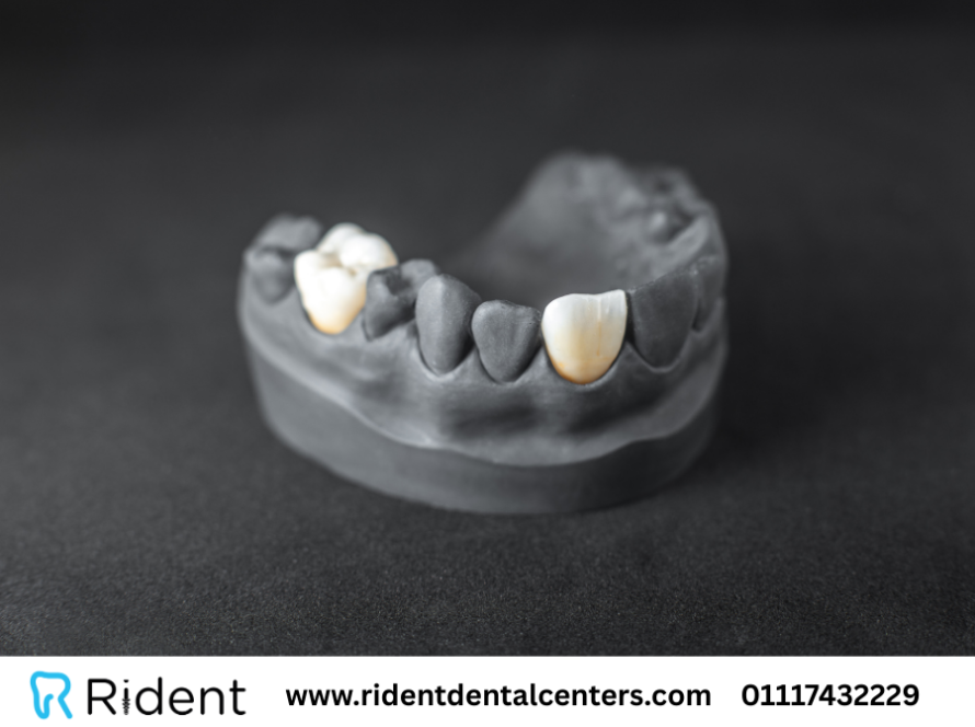 اسعار كراون الاسنان