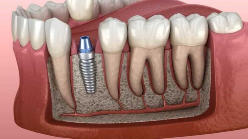 الفرق بين زراعة الأسنان الفورية والتقليدية