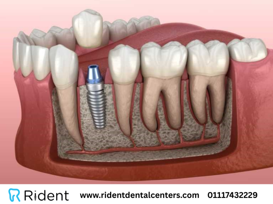الفرق بين زراعة الأسنان الفورية والتقليدية