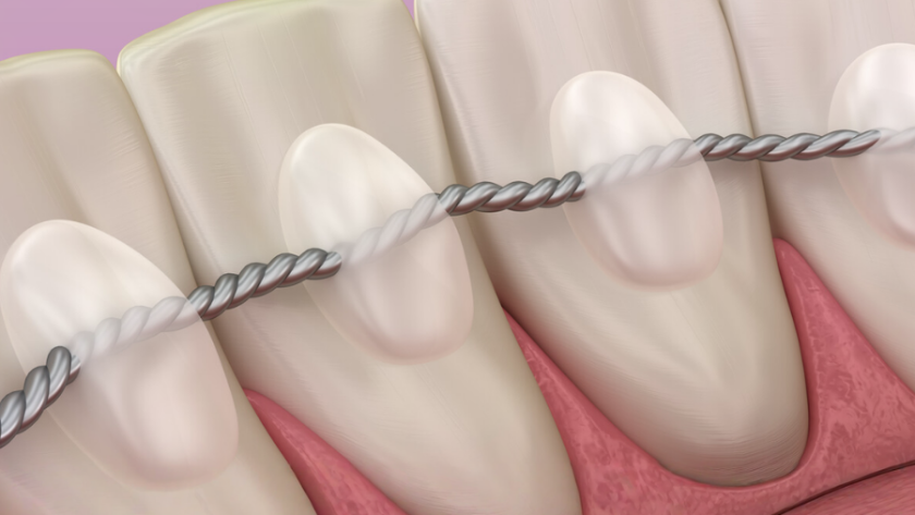 الفرق بين مثبت التقويم الشفاف والحديد، أيهما تختار بعد إزالة التقويم؟