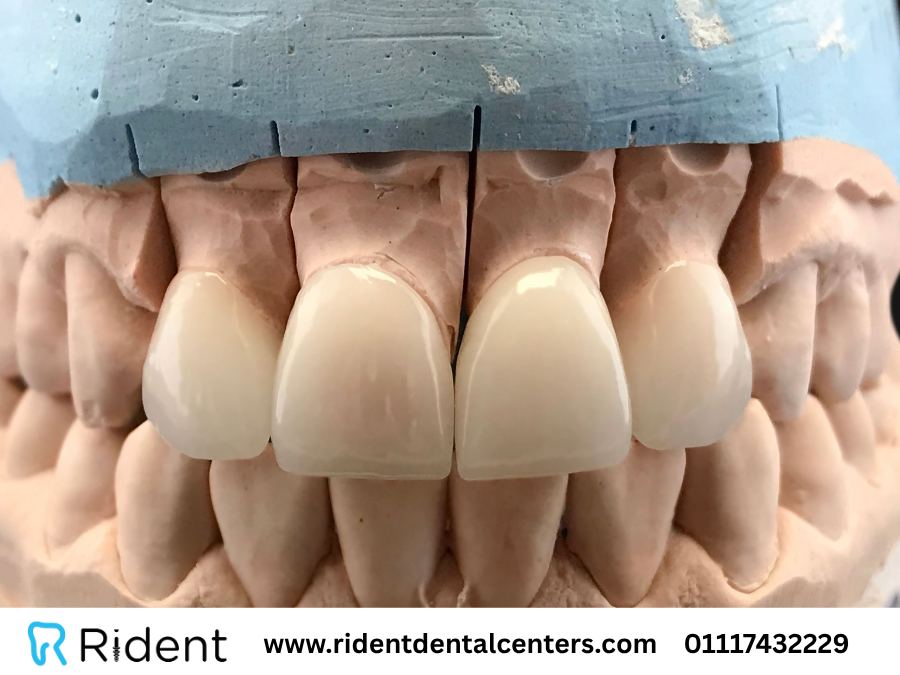 انواع الفينير وفوائده الـ 6 التي لا تعلمها