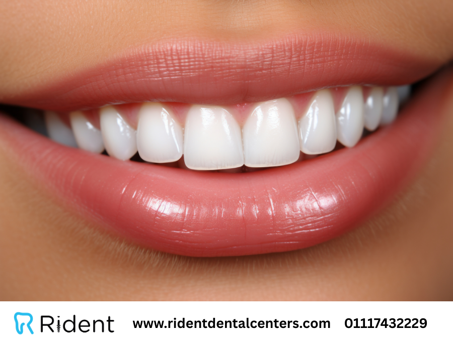 تبييض الاسنان