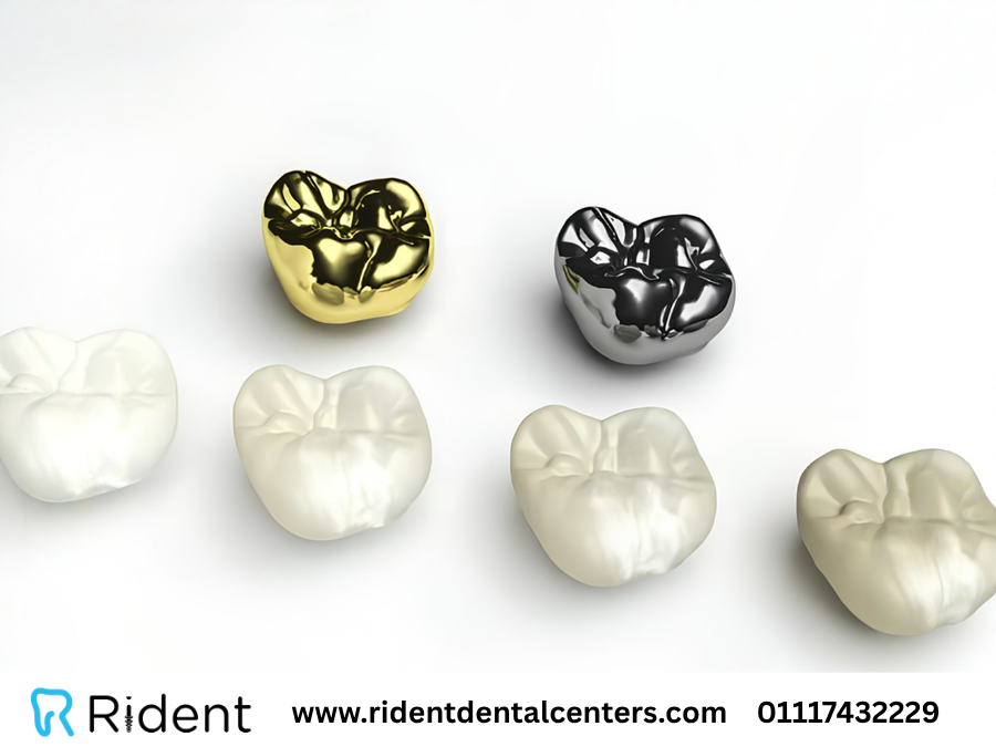 بدائل طربوش الأسنان .. 5 بدائل وما الأفضل من بينها؟