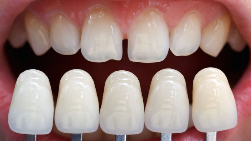 تجميل الاسنان بـ 11 طريقة مختلفة في ملف شامل