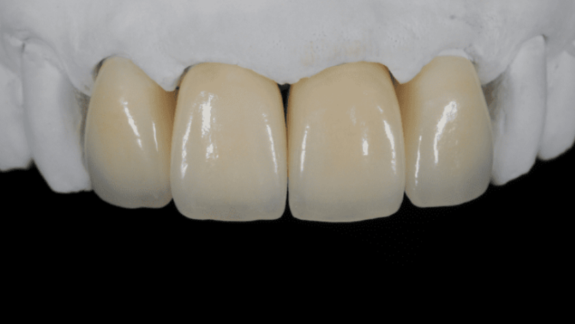 تركيب الزيركون للاسنان الامامية