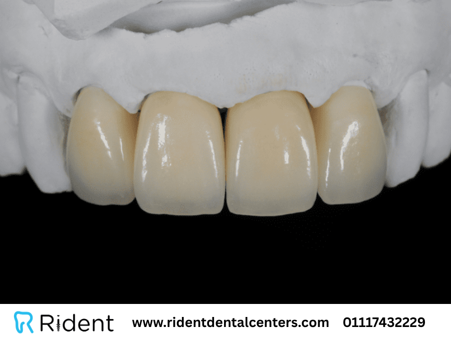 تركيب الزيركون للاسنان الامامية