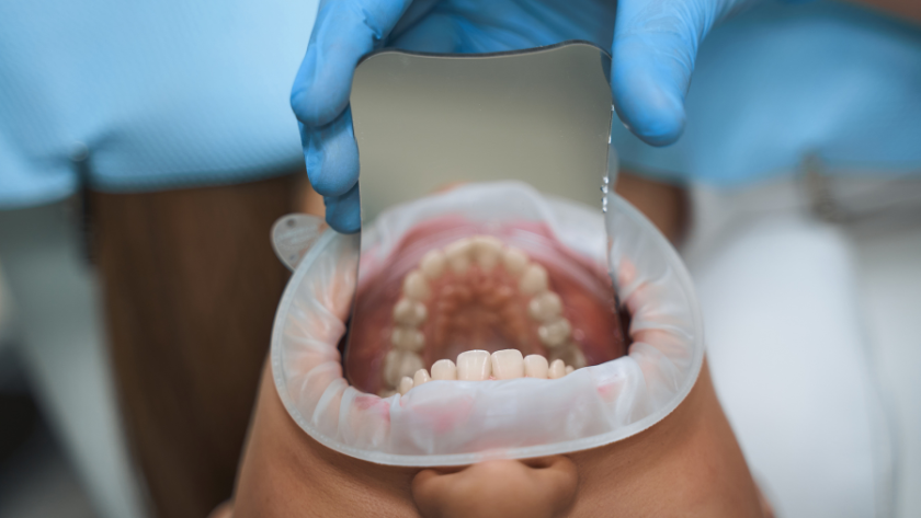 تركيب الضرس بعد الخلع