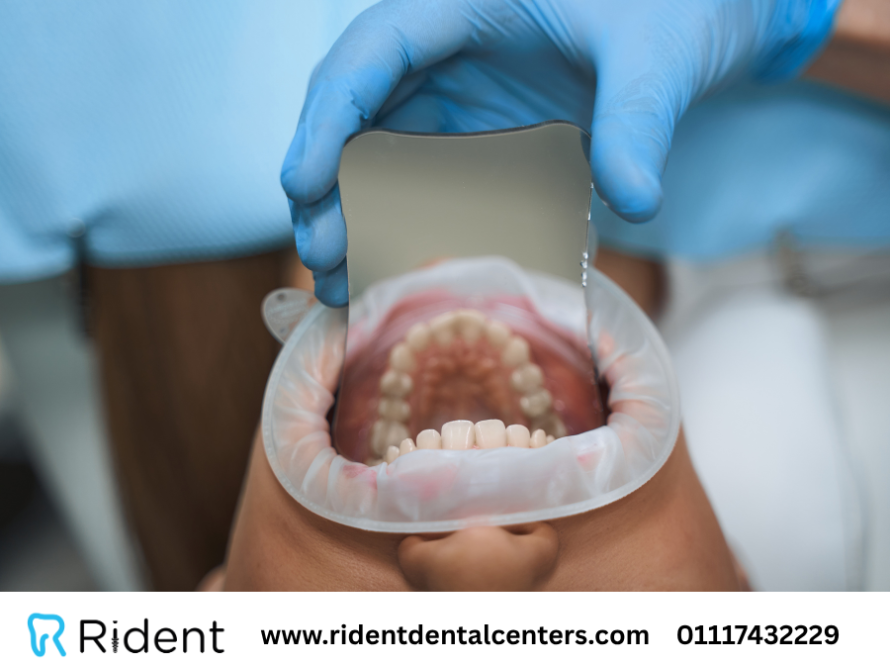 تركيب الضرس بعد الخلع