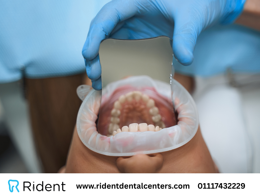 تركيب الضرس بعد الخلع