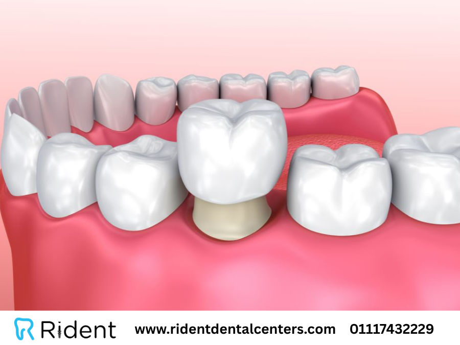تركيب طربوش الاسنان