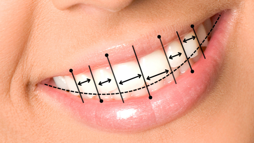 تعرف على مميزات وانواع هوليود سمايل أو ابتسامة هوليود