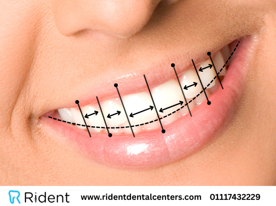 تعرف على مميزات وانواع هوليود سمايل أو ابتسامة هوليود