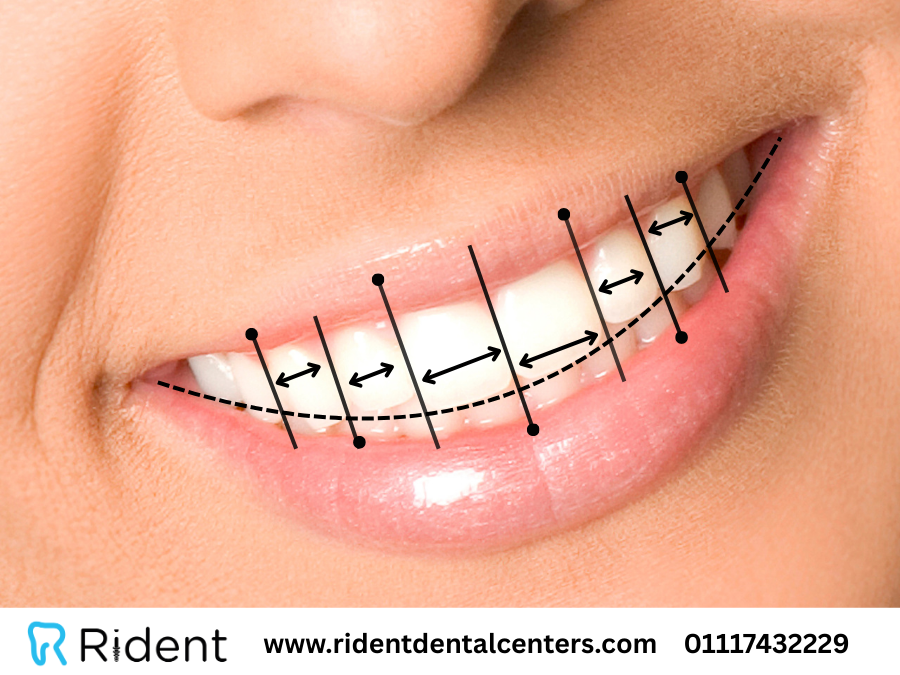 تعرف على مميزات وانواع هوليود سمايل أو ابتسامة هوليود