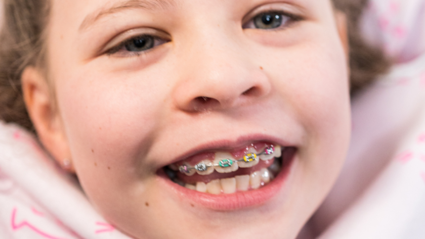 تقويم الاسنان للاطفال