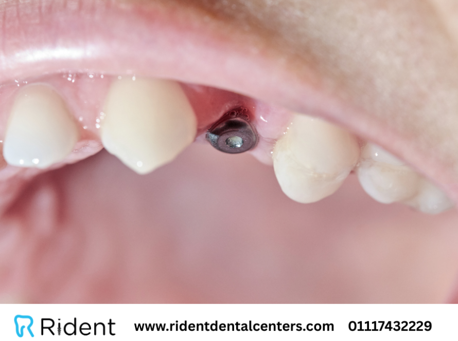 تكلفة زراعة الضرس الواحد