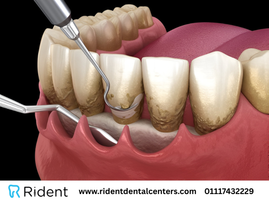 تنظيف الاسنان من الجير في 5 خطوات