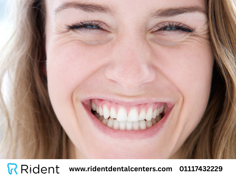 أفضل 3 أنواع حشوات تجميلية لحشو الأسنان الأمامية