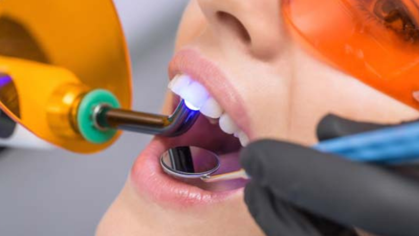 حشو الاسنان بالليزر