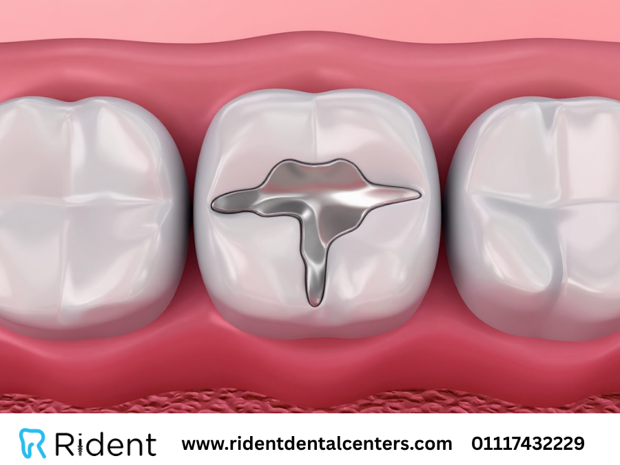 حشو الاسنان لعلاج التسوس والتآكل في 7 خطوات