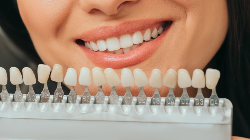 درجات تبييض الأسنان - دليلك لمعرفة درجات تبييض الأسنان