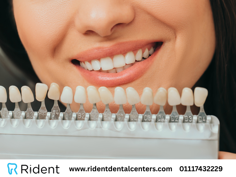 درجات تبييض الأسنان - دليلك لمعرفة درجات تبييض الأسنان