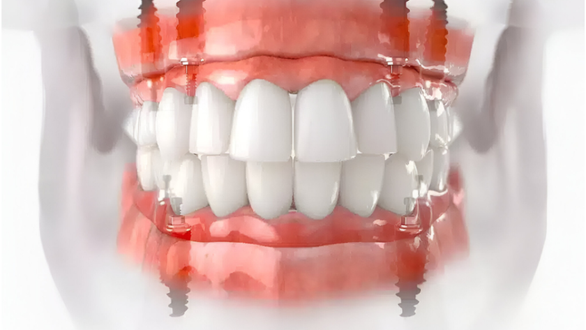 زراعة الأسنان all on 4