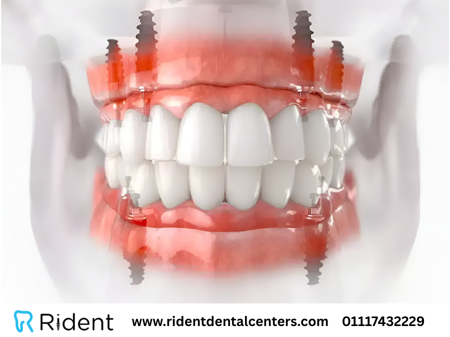 زراعة الأسنان all on 4