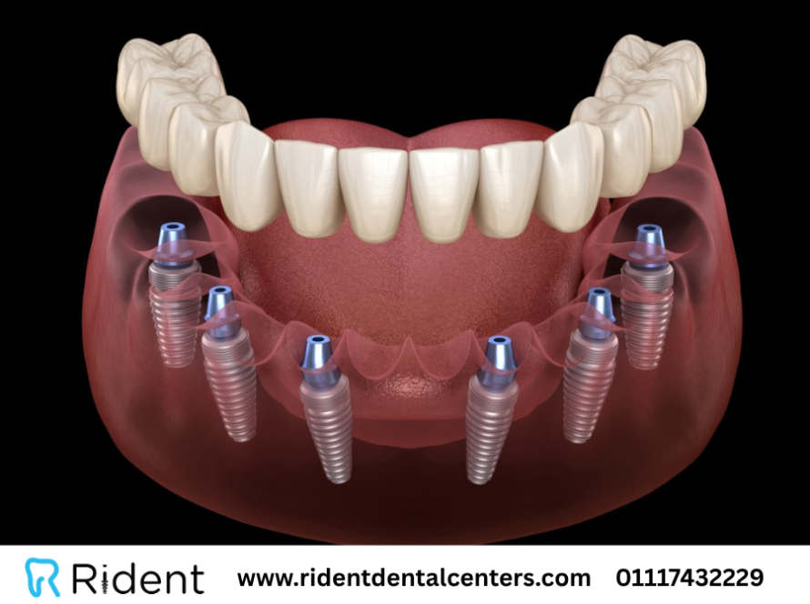 زراعة الأسنان all on 6
