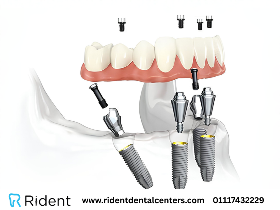 زرع الأسنان الفوري