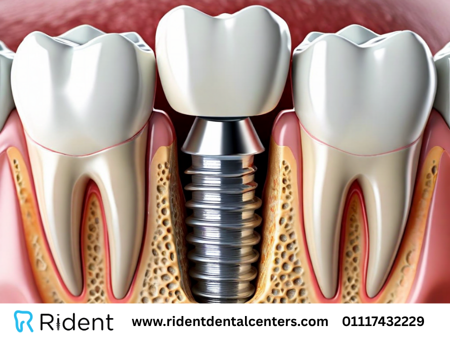 زراعة الاسنان