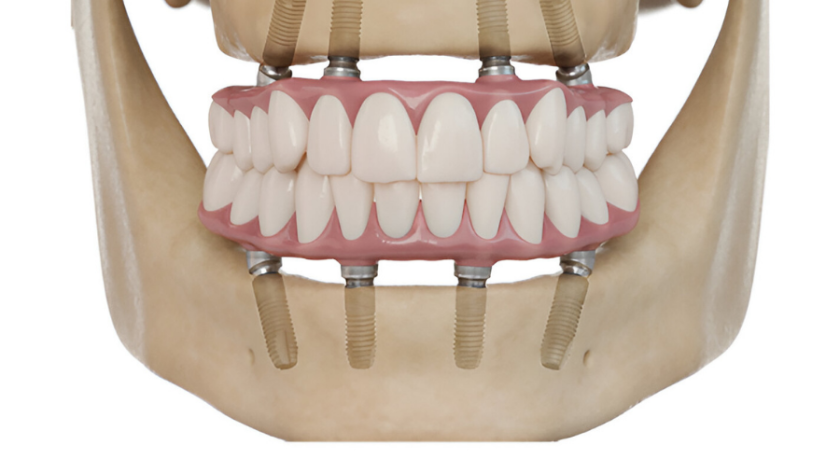 زراعة الفك العلوي بالكامل و6 نصائح لنتائج مذهلة