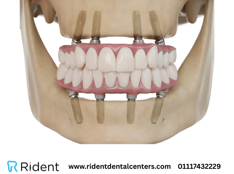 زراعة الفك العلوي بالكامل و6 نصائح لنتائج مذهلة