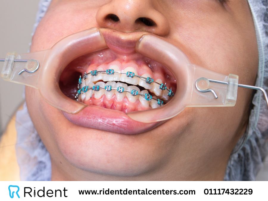 سعر تقويم الاسنان